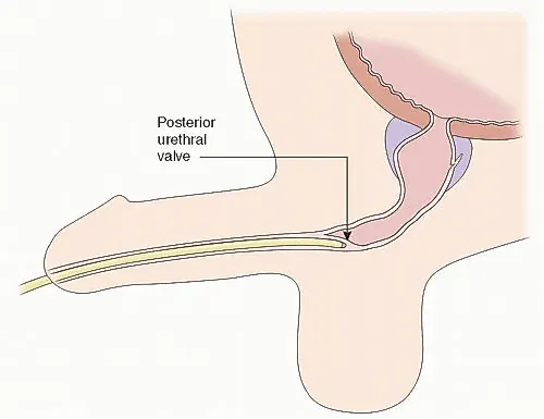 Клапаны  уретры
