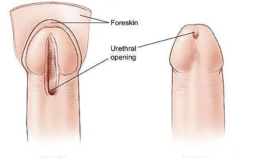 Гипоспадия