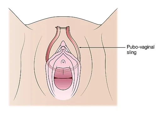 Интерлабиальные объемные образования