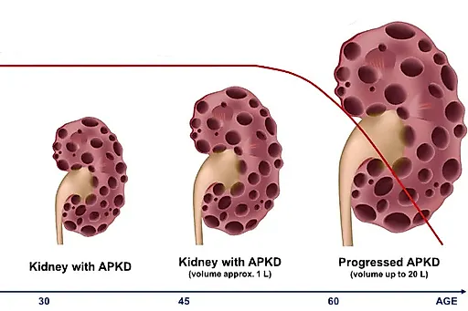 Поликистоз почек у взрослых