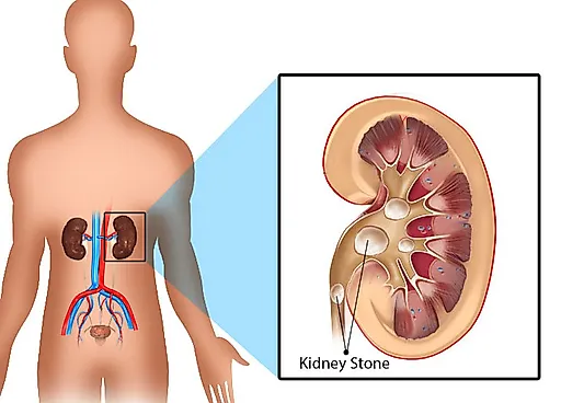 Оксалатный уролитиаз