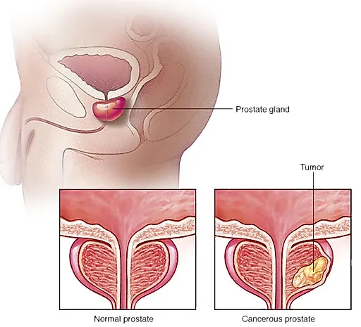 Рак предстательной железы