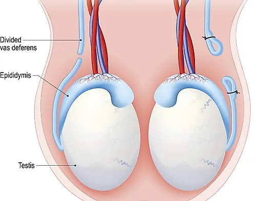 Вазэктомия