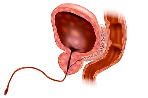 Гонококковые и негонококковые уретриты