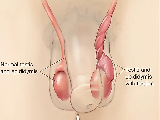 Абсцесс мошонки