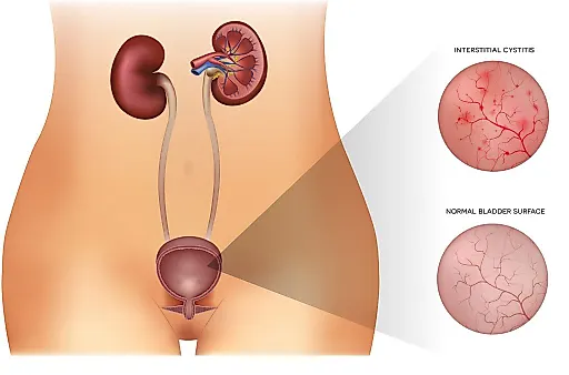 Интерстициальныи цистит