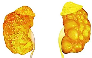 Почечный абсцесс