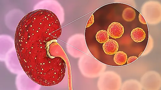 Острый пиелонефрит