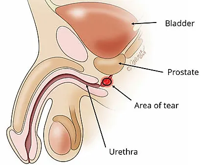 Повреждения мочеиспускательного канала