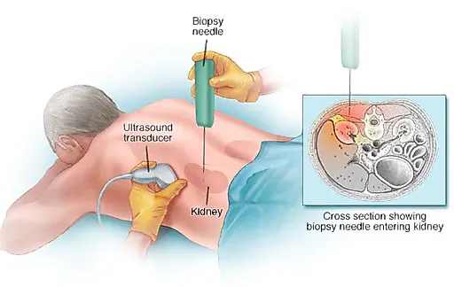 Диагностика почечной недостаточности