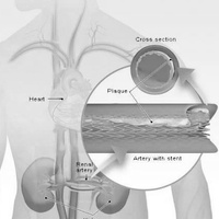 Патология почечной артерии